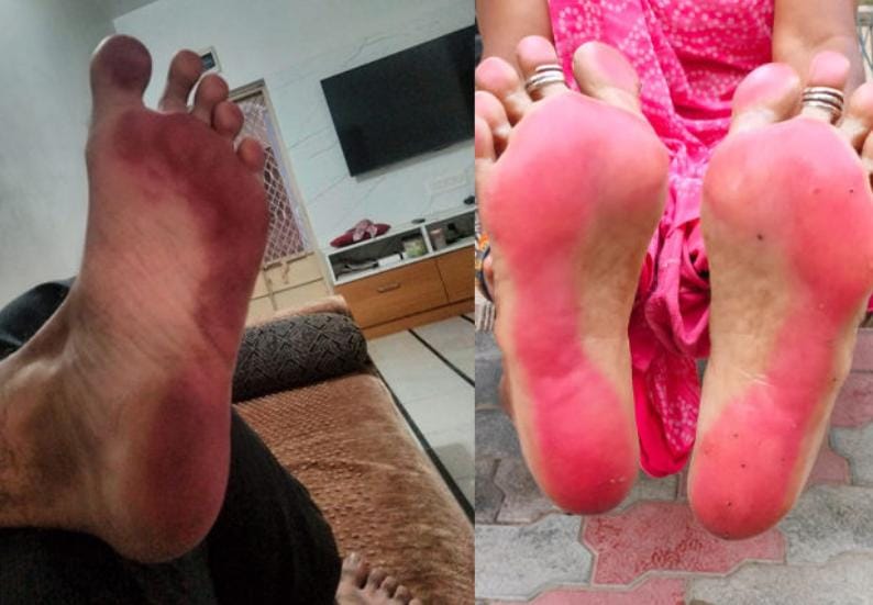 નરોડામાં પ્રદુષણના કારણે પગમાં મહેંદી મુકાઈ