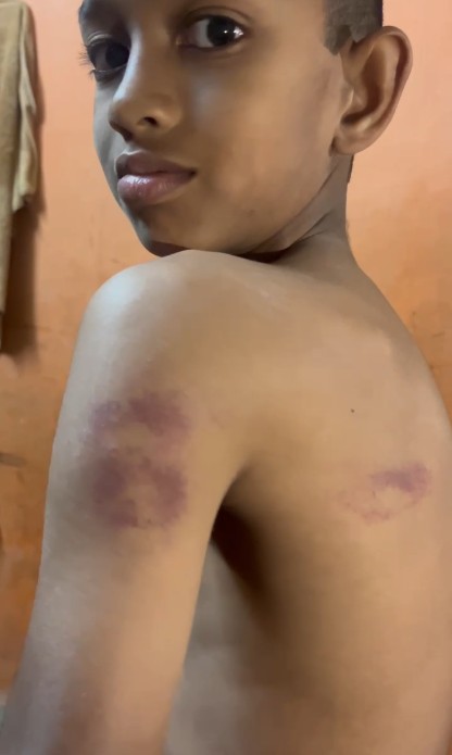 સાવલી ના મોક્સી પ્રાથમિક સ્કૂલની વિદ્યાર્થીને સ્કૂલના શિક્ષકે માર માર્યો 